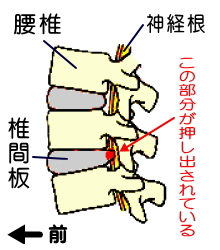 椎間板ヘルニアの図